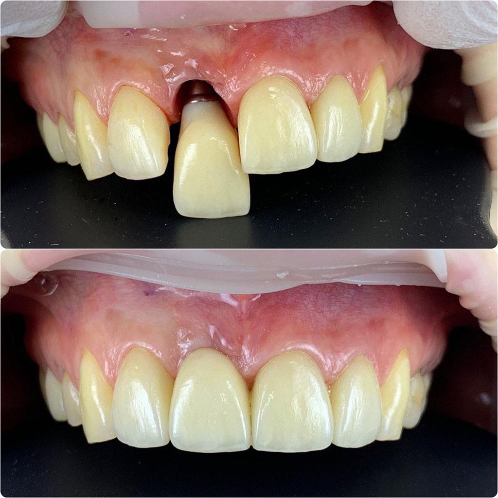 Имплантация зуба в клинике Zubest