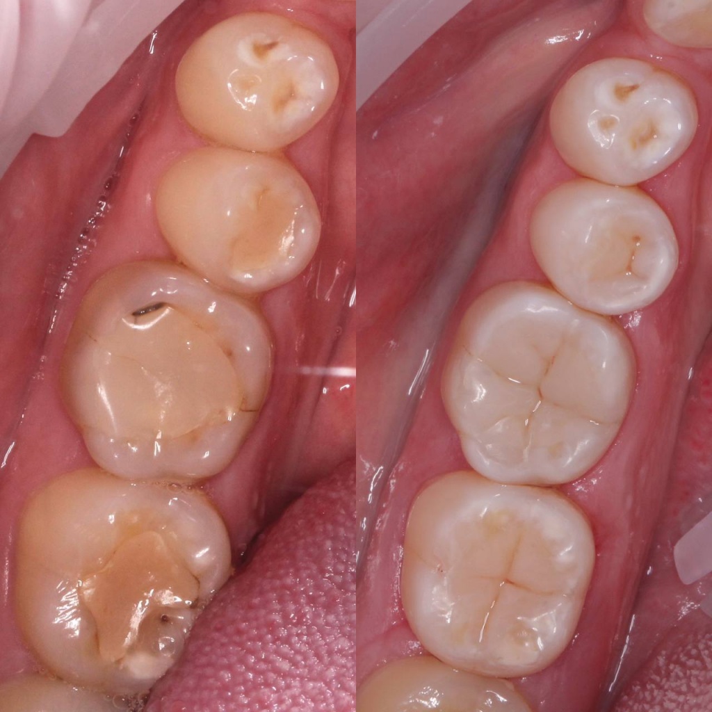 Работа по gовторной эндодонтии 37 зуба в клинике Zubest