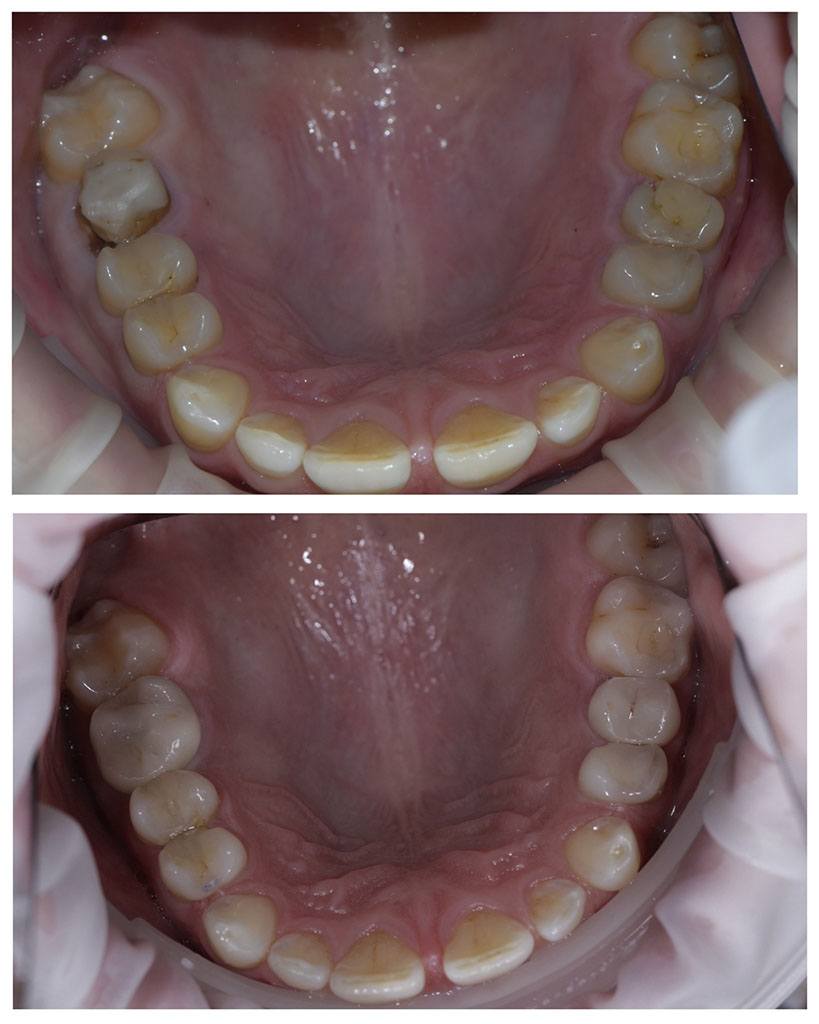 Установка керамической коронки на 16й зуб в клинике Zubest
