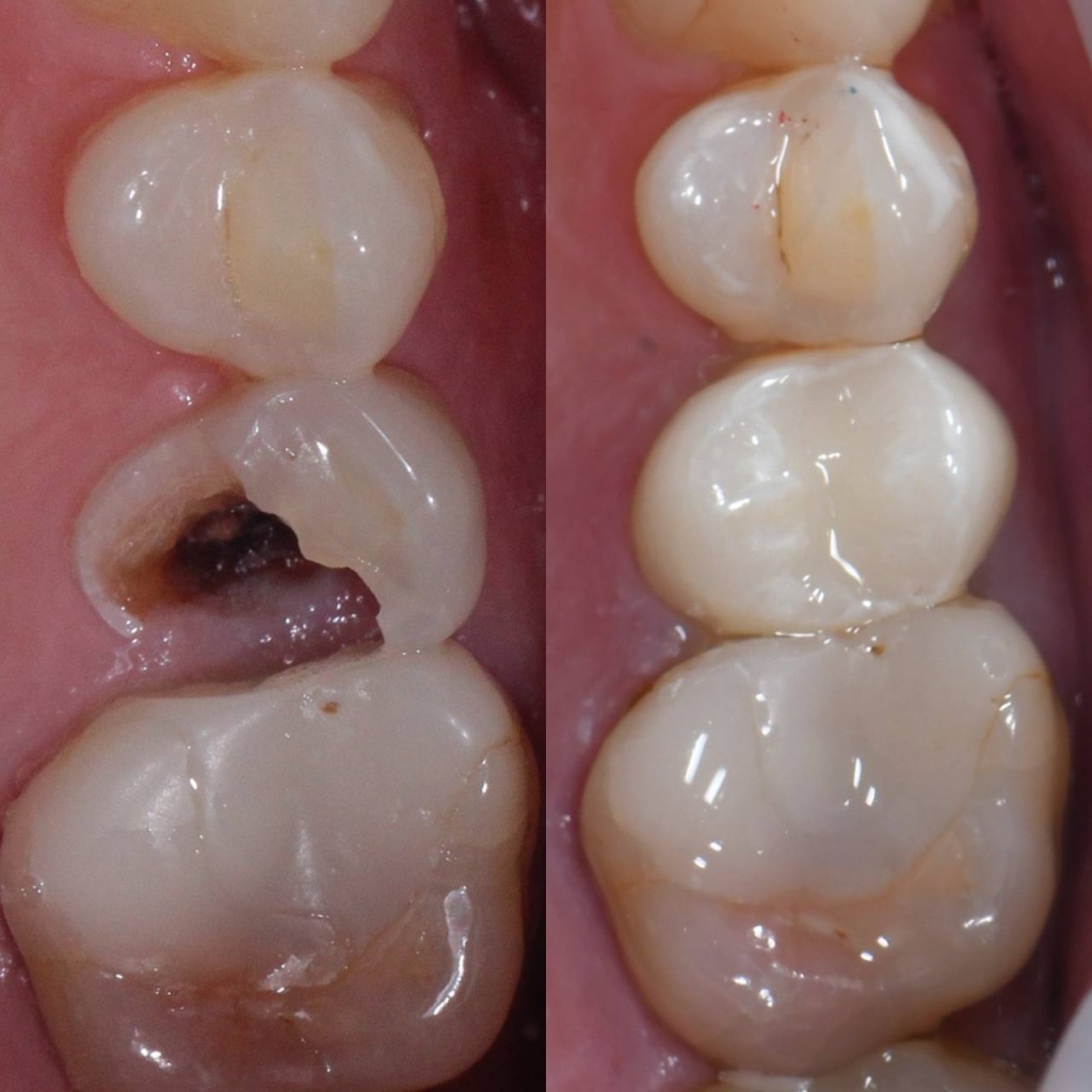 Реставрации боковых групп зубов в клинике Zubest