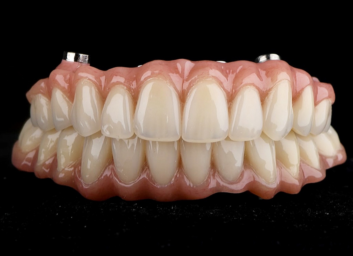 Делаем невозможное! Новые зубы «на 4х имплантах» за 24 часа.